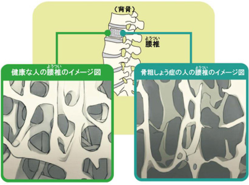骨粗鬆症とは