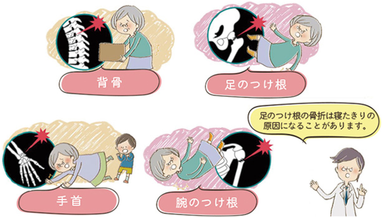 骨粗鬆症の原因